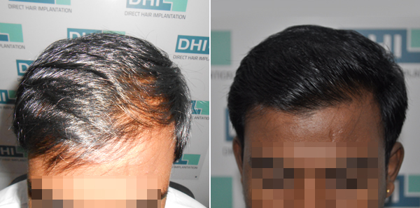 DHI before & after hair transplant results