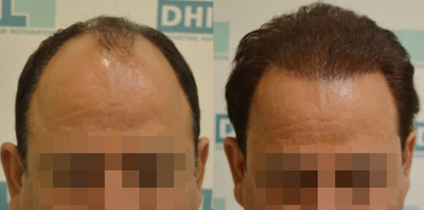 DHI before & after hair transplant results