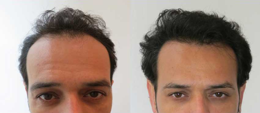 DHI before & after hair transplant results