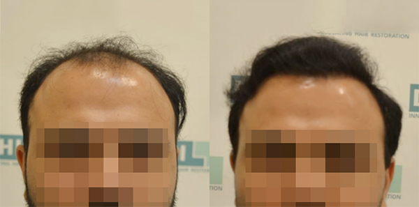 DHI before & after hair transplant results