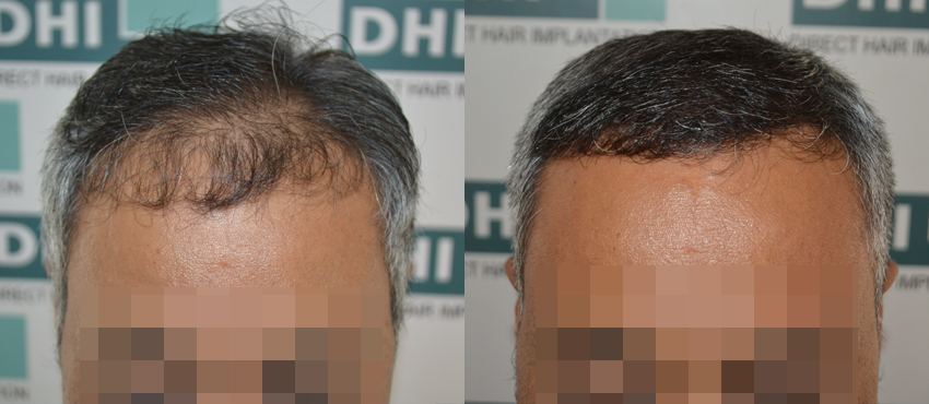 DHI before & after hair transplant results