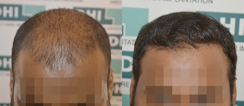 DHI before & after hair transplant results