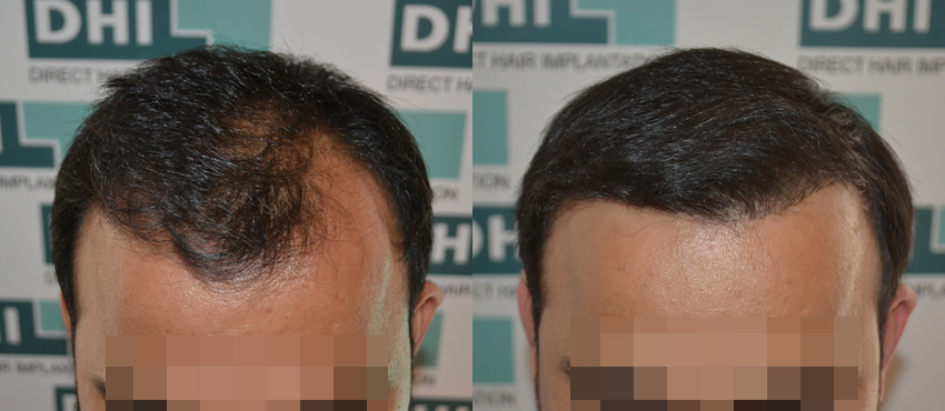 DHI before & after hair transplant results