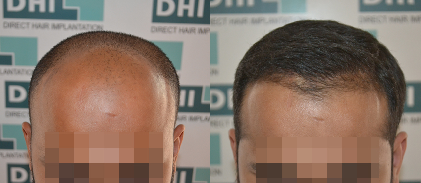 DHI before & after hair transplant results