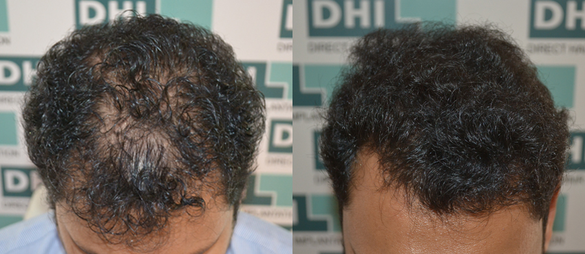 DHI before & after hair transplant results