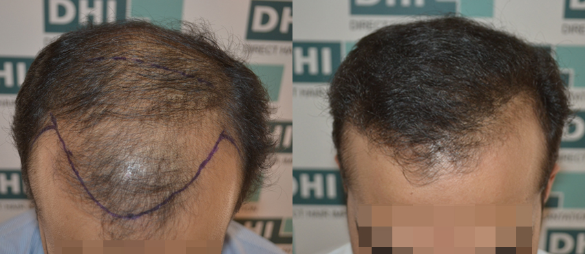 DHI before & after hair transplant results