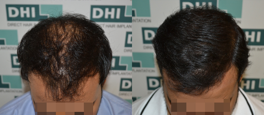 DHI before & after hair transplant results