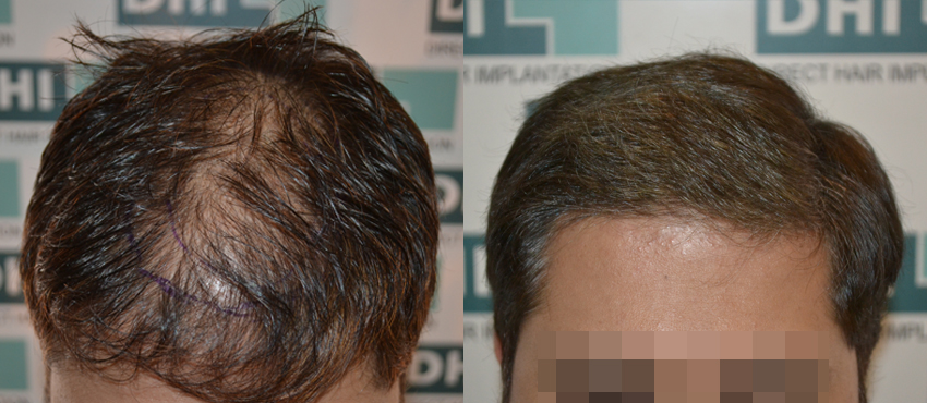 DHI before & after hair transplant results