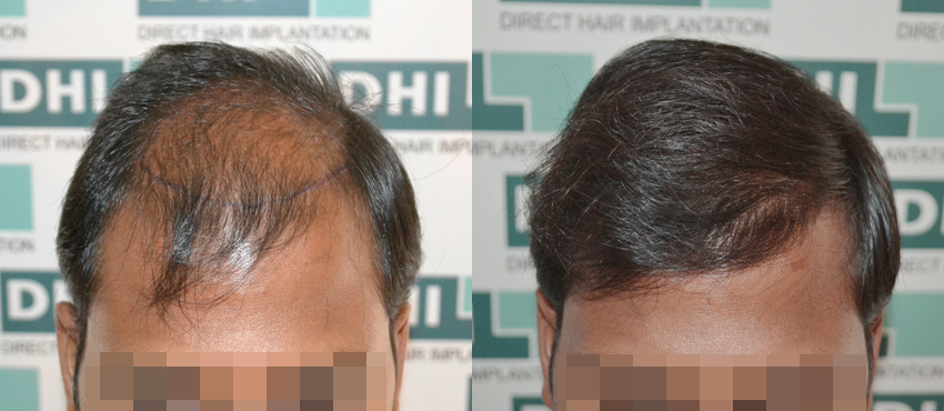 DHI before & after hair transplant results