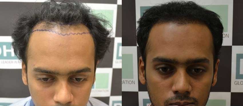 DHI before & after hair transplant results