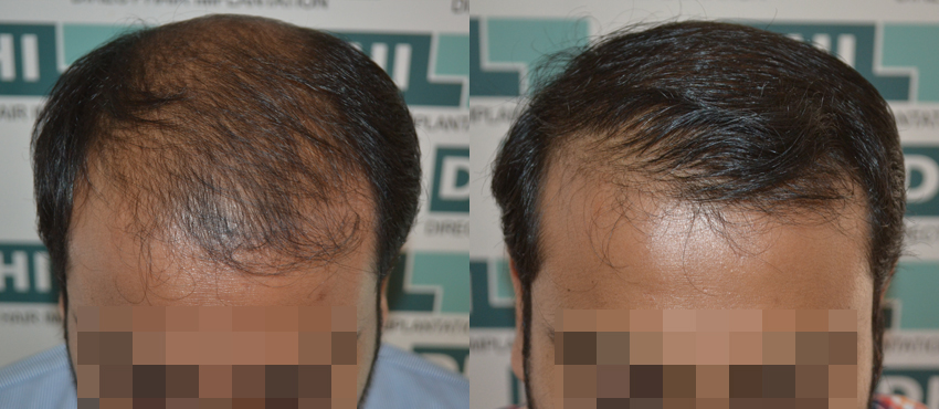 DHI before & after hair transplant results