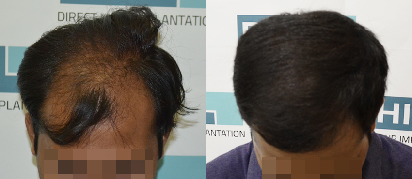 DHI before & after hair transplant results