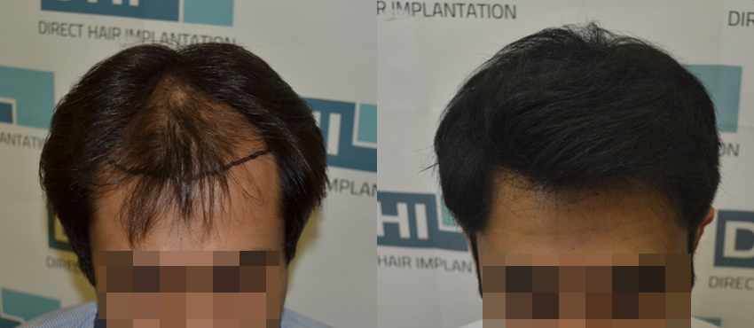 DHI before & after hair transplant results