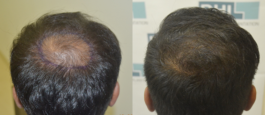 DHI before & after hair transplant results