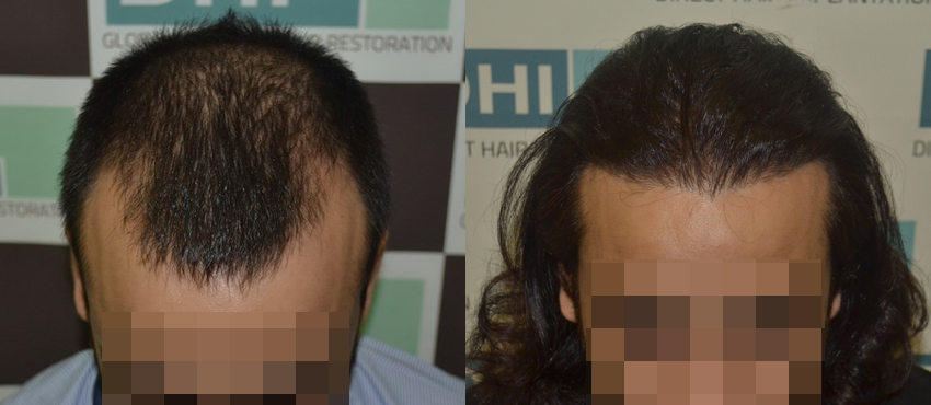 DHI before & after hair transplant results