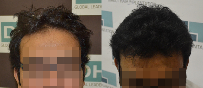 DHI before & after hair transplant results