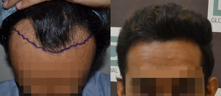 DHI before & after hair transplant results