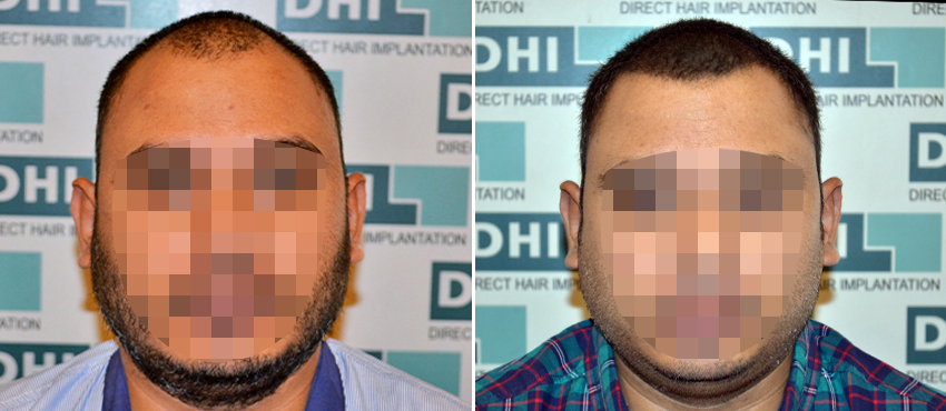 DHI before & after hair transplant results