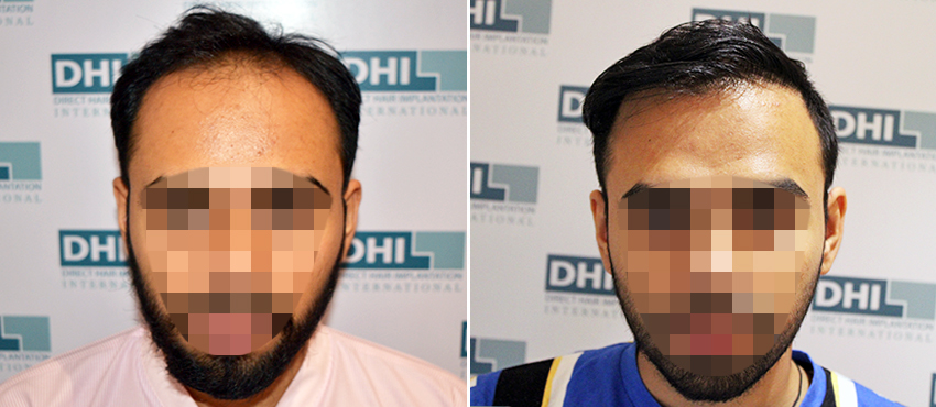 DHI before & after hair transplant results