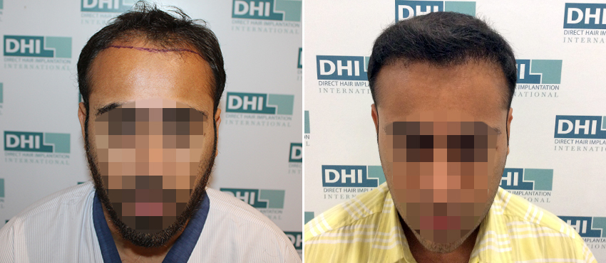 DHI before & after hair transplant results