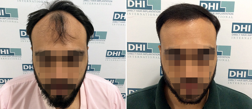 DHI before & after hair transplant results