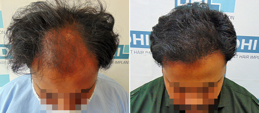 DHI before & after hair transplant results