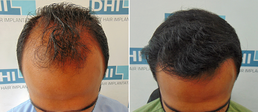 DHI before & after hair transplant results