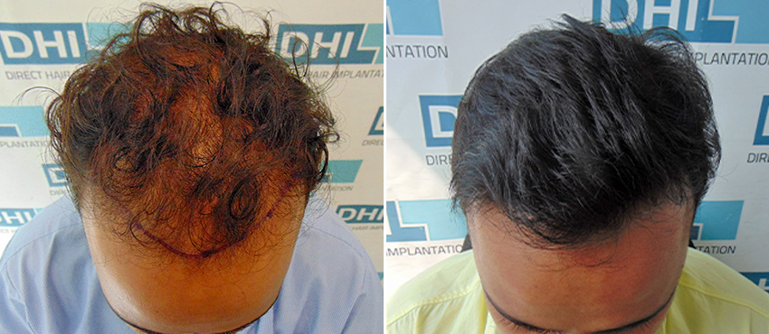 DHI before & after hair transplant results