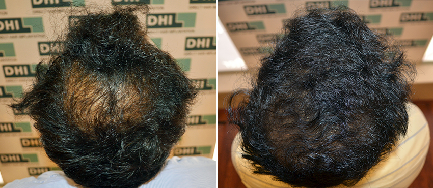 DHI before & after hair transplant results