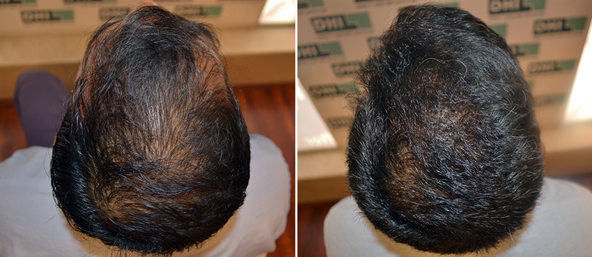 DHI before & after hair transplant results