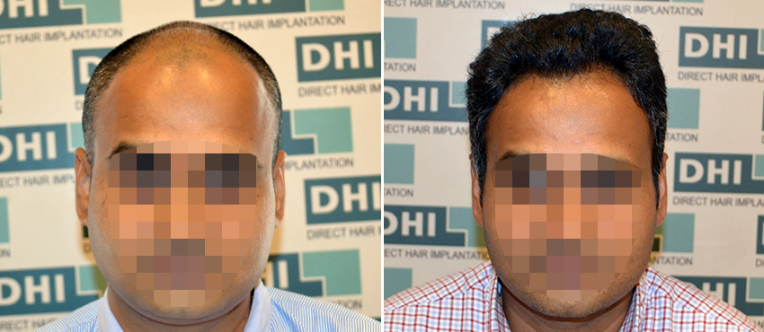 DHI before & after hair transplant results