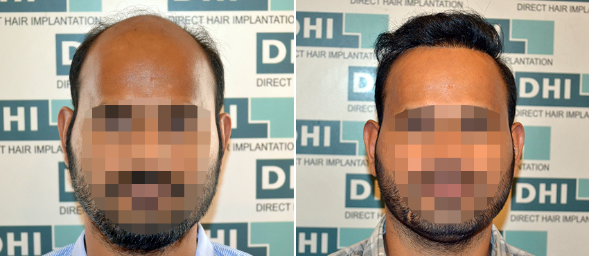 DHI before & after hair transplant results