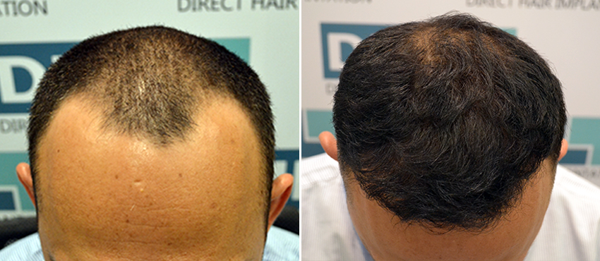 DHI before & after hair transplant results