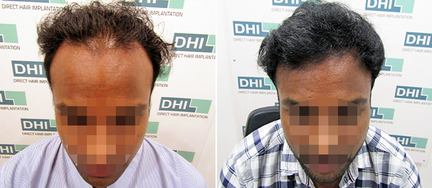 DHI before & after hair transplant results