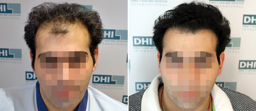 DHI before & after hair transplant results