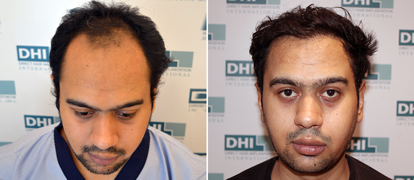 DHI before & after hair transplant results