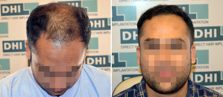 DHI before & after hair transplant results