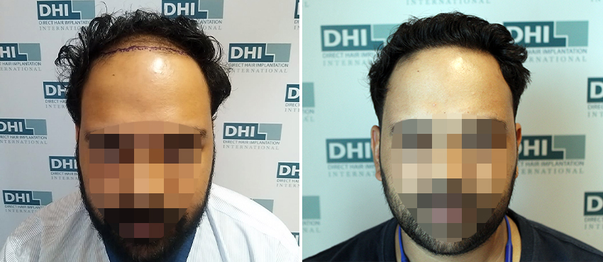 DHI before & after hair transplant results