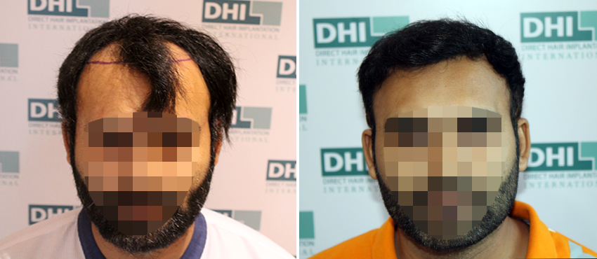 DHI before & after hair transplant results