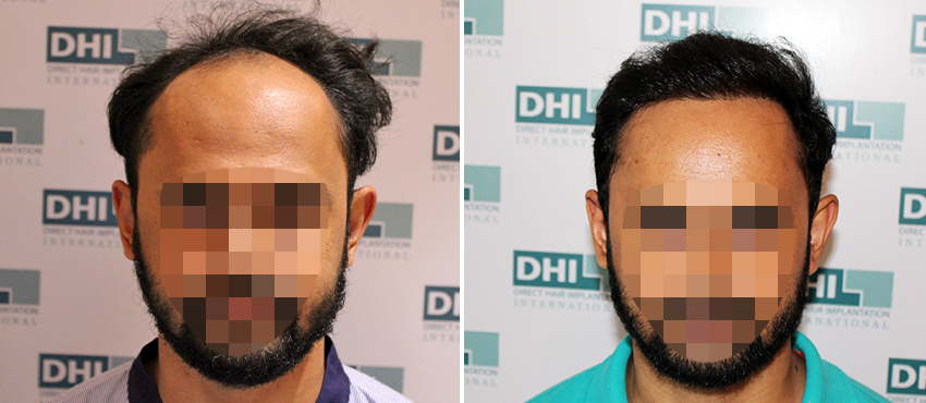 DHI before & after hair transplant results
