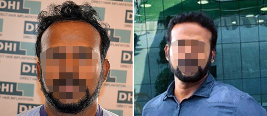 DHI before & after hair transplant results