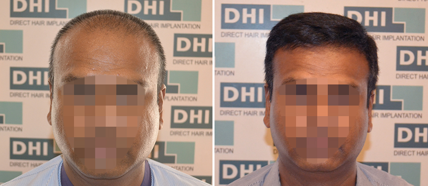 DHI before & after hair transplant results