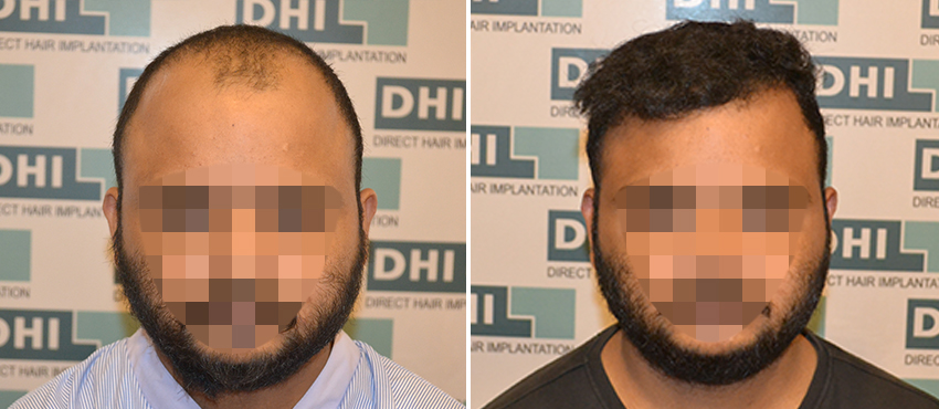 DHI before & after hair transplant results