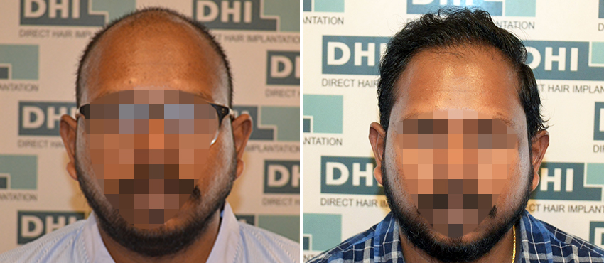 DHI before & after hair transplant results