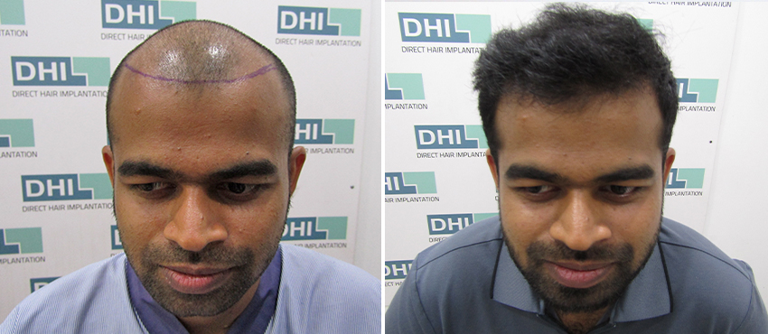 DHI before & after hair transplant results