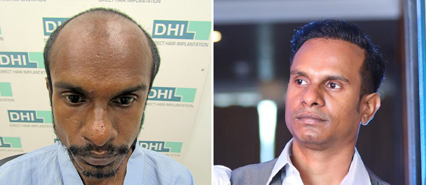 DHI before & after hair transplant results