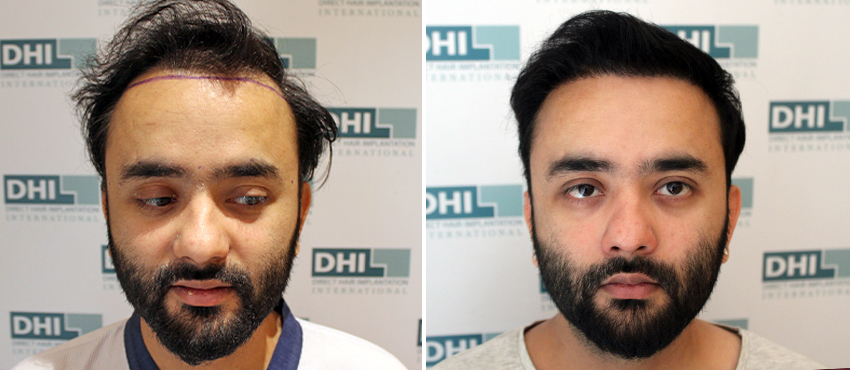 DHI before & after hair transplant results