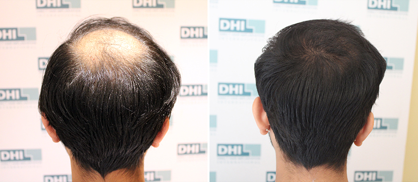 DHI before & after hair transplant results