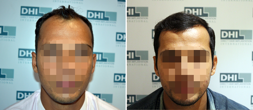 DHI before & after hair transplant results