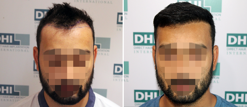 DHI before & after hair transplant results